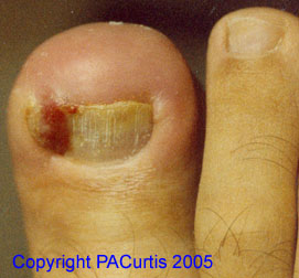 Ingrown nail, tibial border